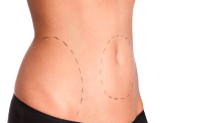 Is Liposuction Permanent?