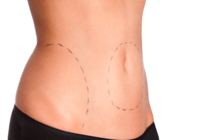 Learn about Liposuction