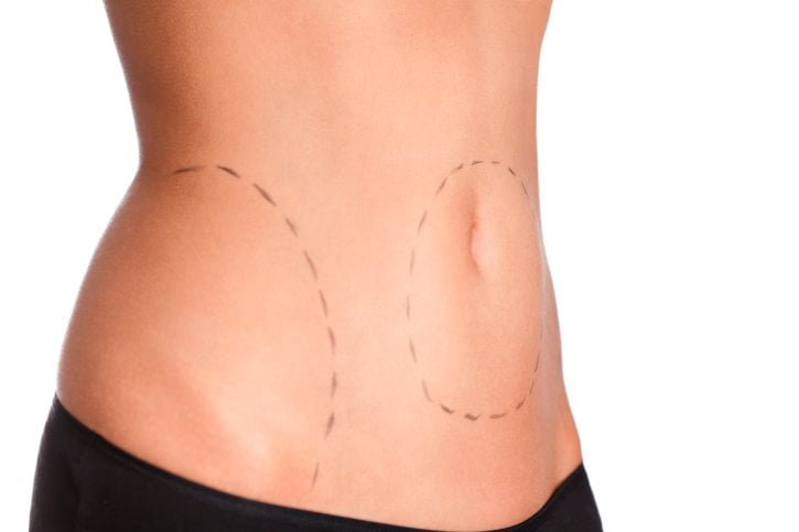 Is Liposuction Permanent?