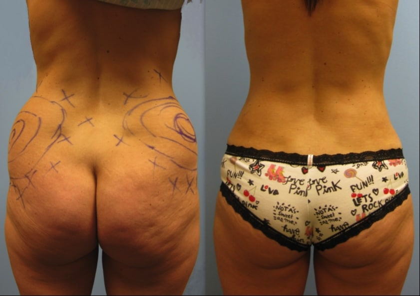 Photo 7: Liposuction of hips. Note improvement in waist and buttocks. No buttock procedures were performed.