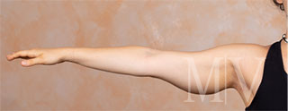 Arm Lift in Vennemeyer Plastic Surgery