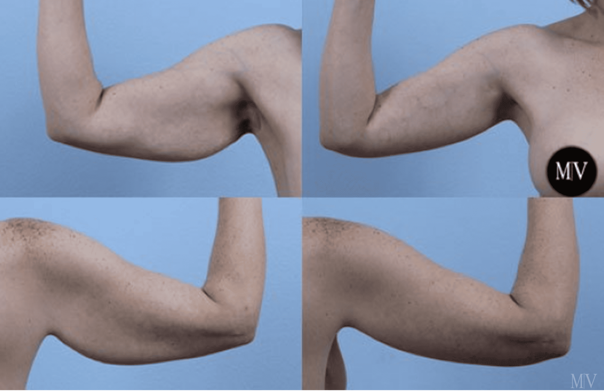 Before and after result of arm-lift at Vennemeyer Plastic Surgery