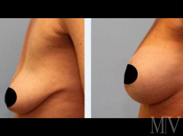 Before and After Breast reduction