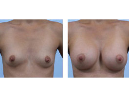 breast augmentation Case 5