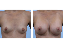 breast augmentation Case 5