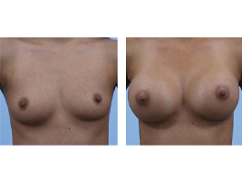 breast augmentation Case 6