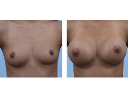 breast augmentation Case 6