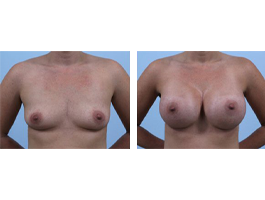 breast augmentation Case 8