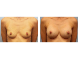breast augmentation Case 1