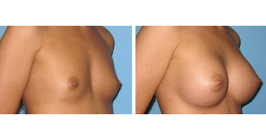 Breast Augmentation Case 11