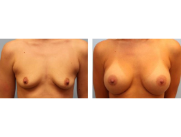 breast augmentation Case 2