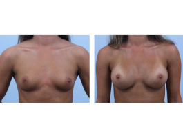 breast augmentation Case 3