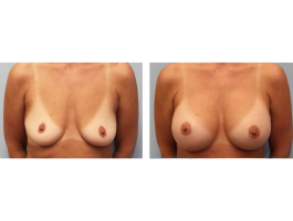 breast augmentation Case 4