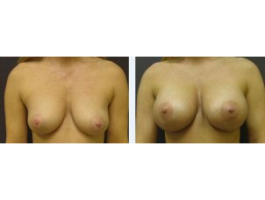 breast augmentation Case 7