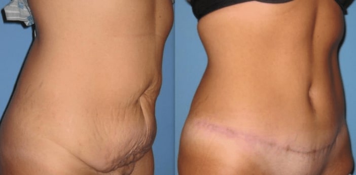 Photo 1: Loose skin and stretch marks improved with tummy tuck. Patient shown 3 months post-op. Additional scar fading occurs over first year.