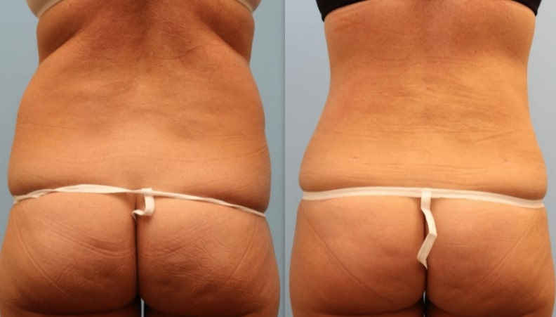 Photo 6: 360 Lipo and tummy tuck. Note improvement in hourglass shape.