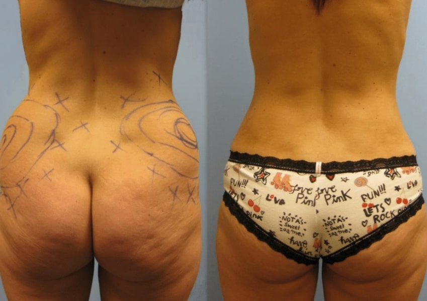 Photo 7: Liposuction of hips. Note improvement in waist and buttocks. No buttock procedures were performed.
