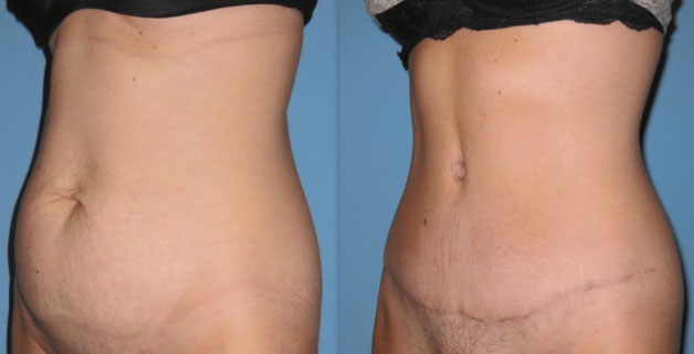 Photo 9: Waistline improved and tummy flattened with tummy tuck. Patient shown 3 months post-op. Additional scar fading occurs over first year.